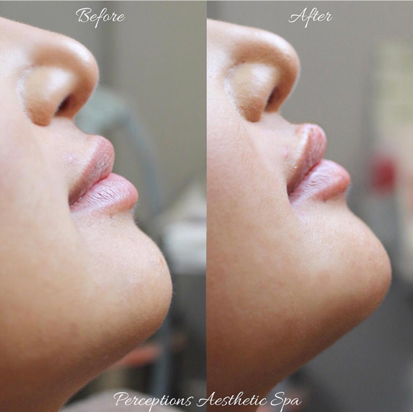 before and after chin filler treatment at perceptions aesthetic spa in fairoaks and roseville, ca