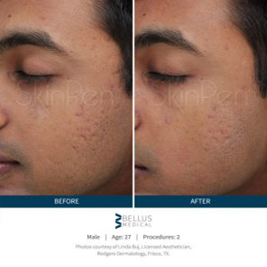 skinpen before and after treatment in fairoaks and roseville, ca