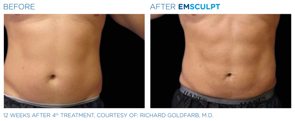 emsculpt treatment before and after male abs in fair oaks and roseville, ca