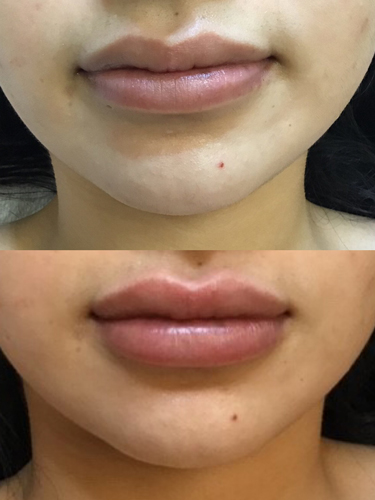 lip filler before and after at perceptions aesthetic spa in fairoaks and roseville, ca